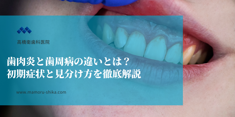 歯肉炎と歯周病の違いとは？初期症状と見分け方を徹底解説