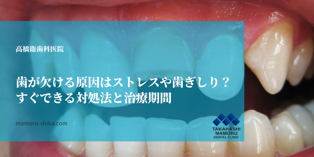歯が欠ける原因はストレスや歯ぎしり？すぐできる対処法と治療期間
