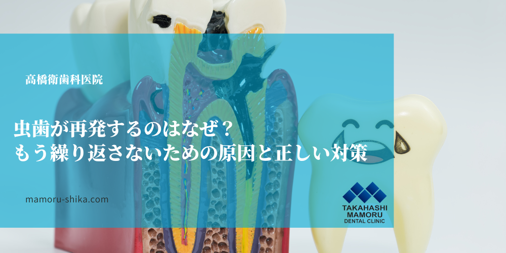 虫歯が再発するのはなぜ？もう繰り返さないための原因と正しい対策