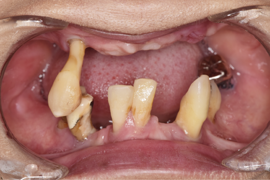 岩手県盛岡市の歯医者・インプラント歯科「高橋衛歯科医院」｜オールオン4＆ザイゴマインプラント症例4