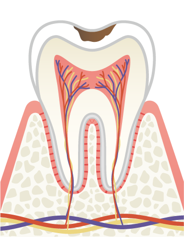 岩手県盛岡市の歯医者・インプラント歯科「高橋衛歯科医院」｜C1 エナメル質の虫歯のイメージ