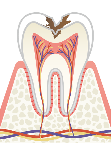 岩手県盛岡市の歯医者・インプラント歯科「高橋衛歯科医院」｜C2 象牙室まで進んだ虫歯のイメージ