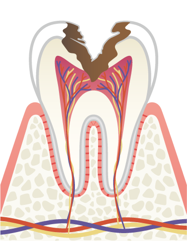 岩手県盛岡市の歯医者・インプラント歯科「高橋衛歯科医院」｜C3 神経まで進んだ虫歯のイメージ