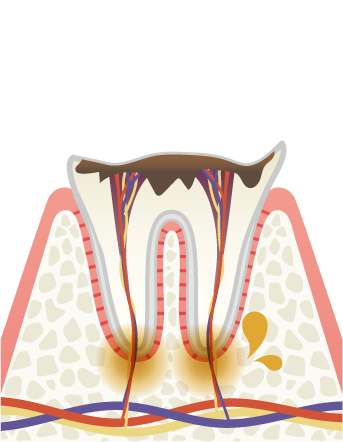 岩手県盛岡市の歯医者・インプラント歯科「高橋衛歯科医院」｜C4 歯が溶けて歯根だけ残った歯のイメージ