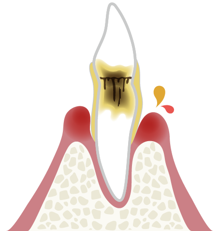 岩手県盛岡市の歯医者・インプラント歯科「高橋衛歯科医院」｜中度歯周炎のイメージ