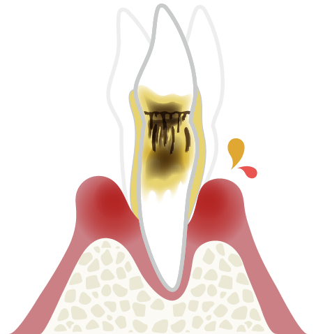 岩手県盛岡市の歯医者・インプラント歯科「高橋衛歯科医院」｜重度歯周炎のイメージ