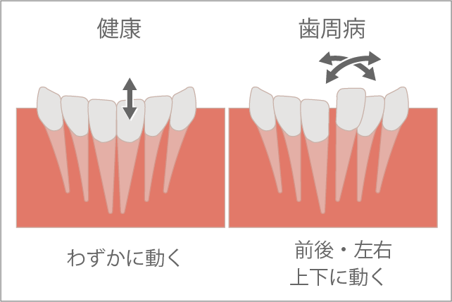 岩手県盛岡市の歯医者・インプラント歯科「高橋衛歯科医院」｜動揺度検査のイメージ