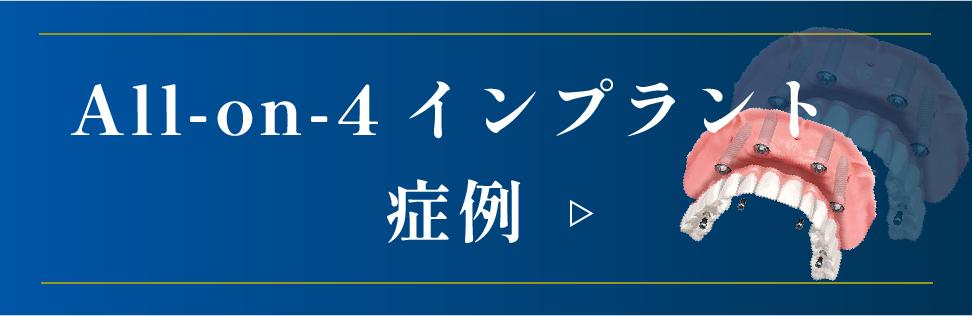 All-on-4インプラント症例はこちら