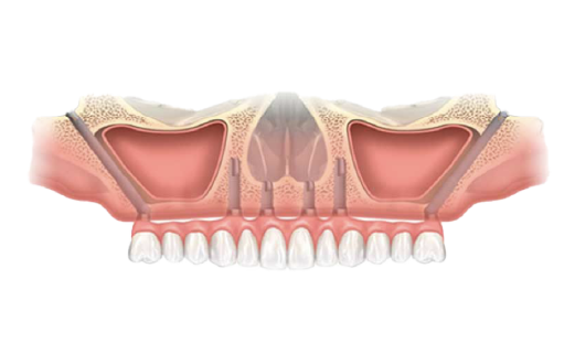 ザイゴマインプラントのイメージ