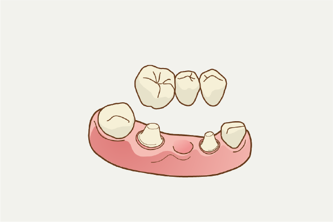 岩手県盛岡市の歯医者・インプラント歯科「高橋衛歯科医院」｜ブリッジイメージ