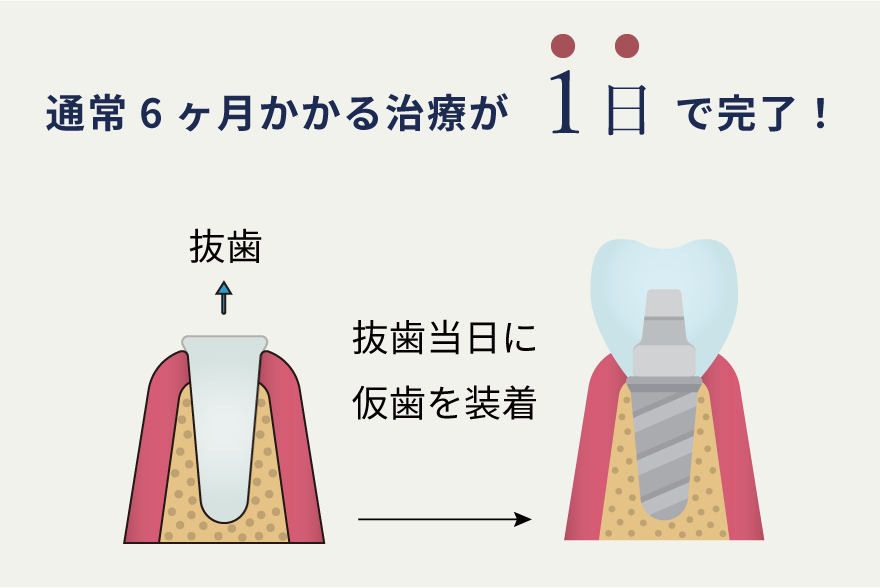 岩手県盛岡市の歯医者・インプラント歯科「高橋衛歯科医院」｜抜歯即時埋入インプラントのイメージ