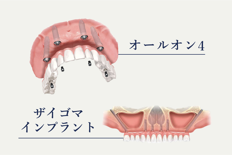 岩手県盛岡市の歯医者・インプラント歯科「高橋衛歯科医院」｜オールオン4、ザイゴマインプラントのイメージ図