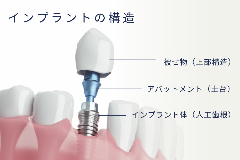岩手県盛岡市の歯医者・インプラント歯科「高橋衛歯科医院」｜インプラントの構造