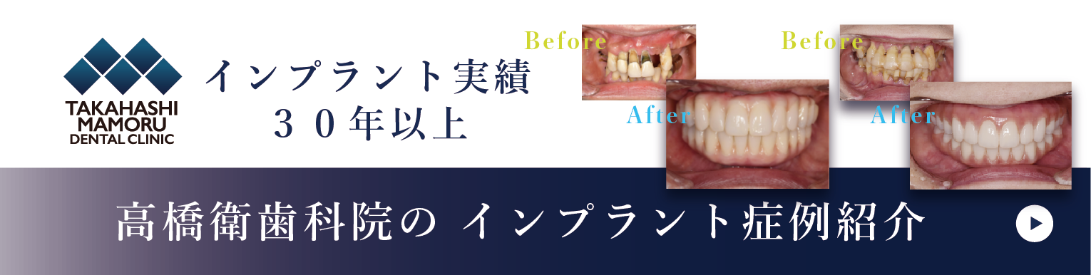 岩手県盛岡市の歯医者・インプラント歯科「高橋衛歯科医院」｜高橋衛歯科医院のインプラント症例紹介リンク