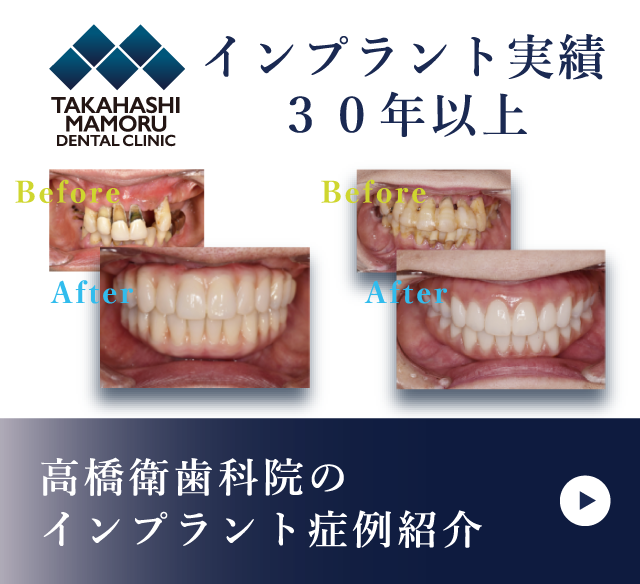 岩手県盛岡市の歯医者・インプラント歯科「高橋衛歯科医院」｜高橋衛歯科医院のインプラント症例紹介リンク