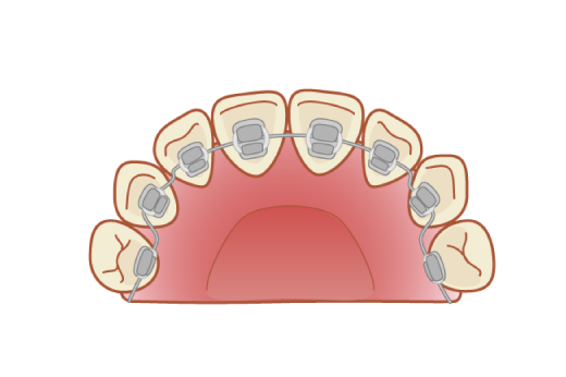 岩手県盛岡市の歯医者・インプラント歯科「高橋衛歯科医院」｜裏側矯正のイメージ図