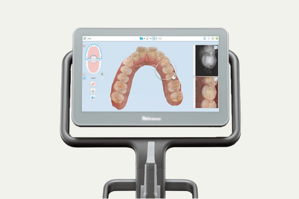 岩手県盛岡市の歯医者・インプラント歯科「高橋衛歯科医院」｜口腔内スキャナーの機器