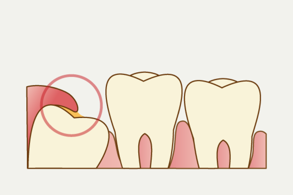 岩手県盛岡市の歯医者・インプラント歯科「高橋衛歯科医院」｜親知らずが一部埋まっているイメージ