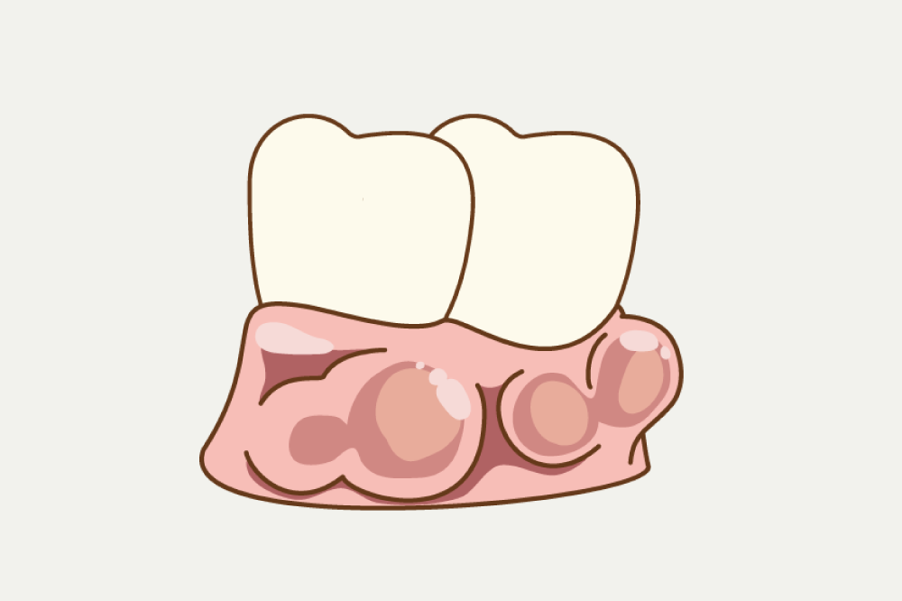 岩手県盛岡市の歯医者・インプラント歯科「高橋衛歯科医院」｜歯ぐきにできるコブのような見た目の骨隆起イメージ