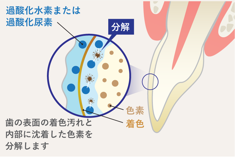 岩手県盛岡市の歯医者・インプラント歯科「高橋衛歯科医院」｜医療ホワイトニングでは歯の表面と内部の色素を分解できるイメージ