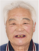治療前の顔写真