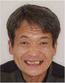治療前の顔写真