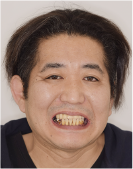 治療前の顔写真