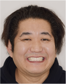 治療前の顔写真