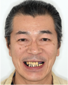 治療前の顔写真