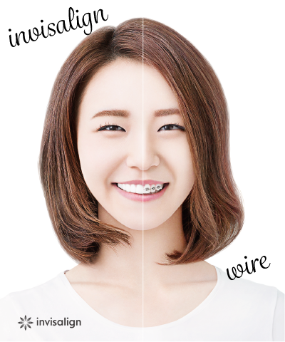 インビザラインとワイヤー矯正の比較